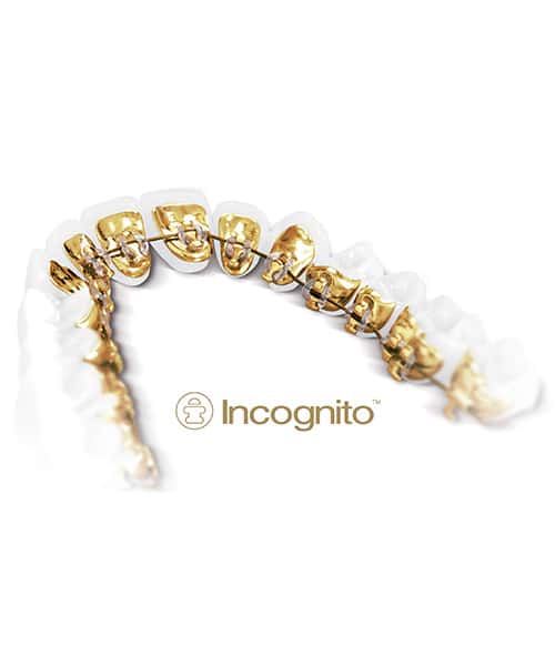 Lingual Braces