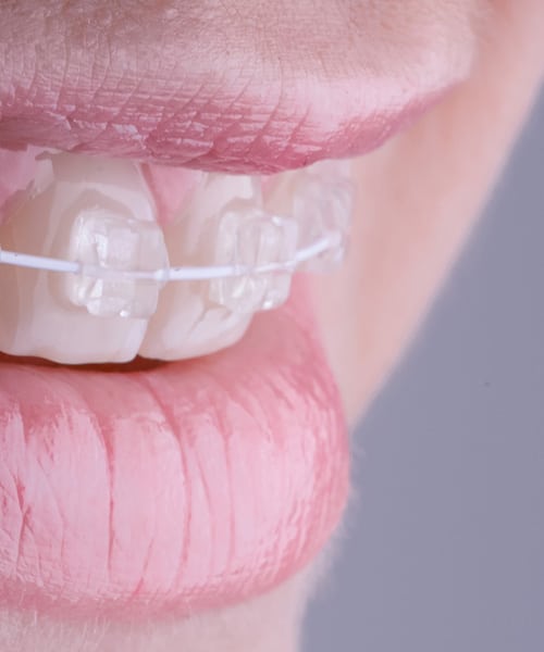 Clear Braces in Ruislip  Fixed Braces for Adults in Ruislip