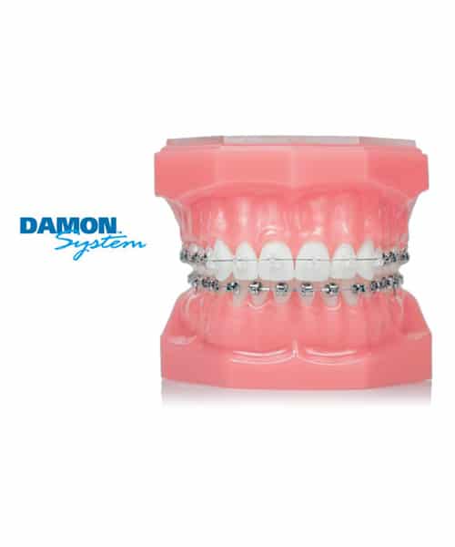 Damon Braces