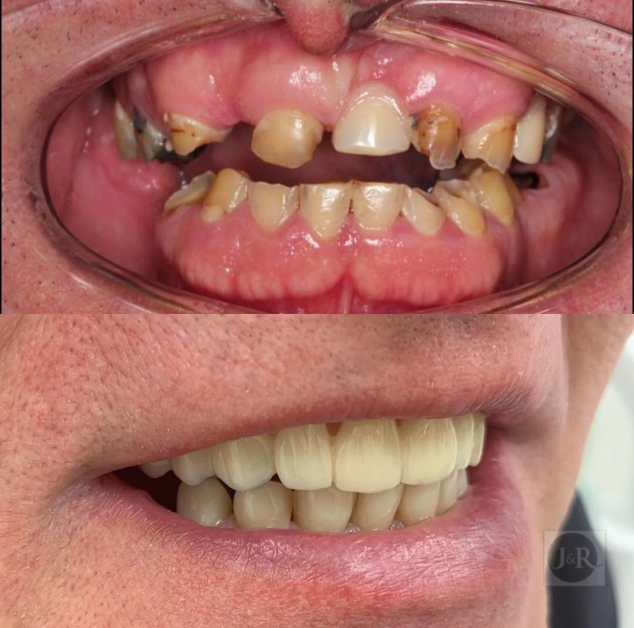dental-implant-jandr-dental1.jpeg