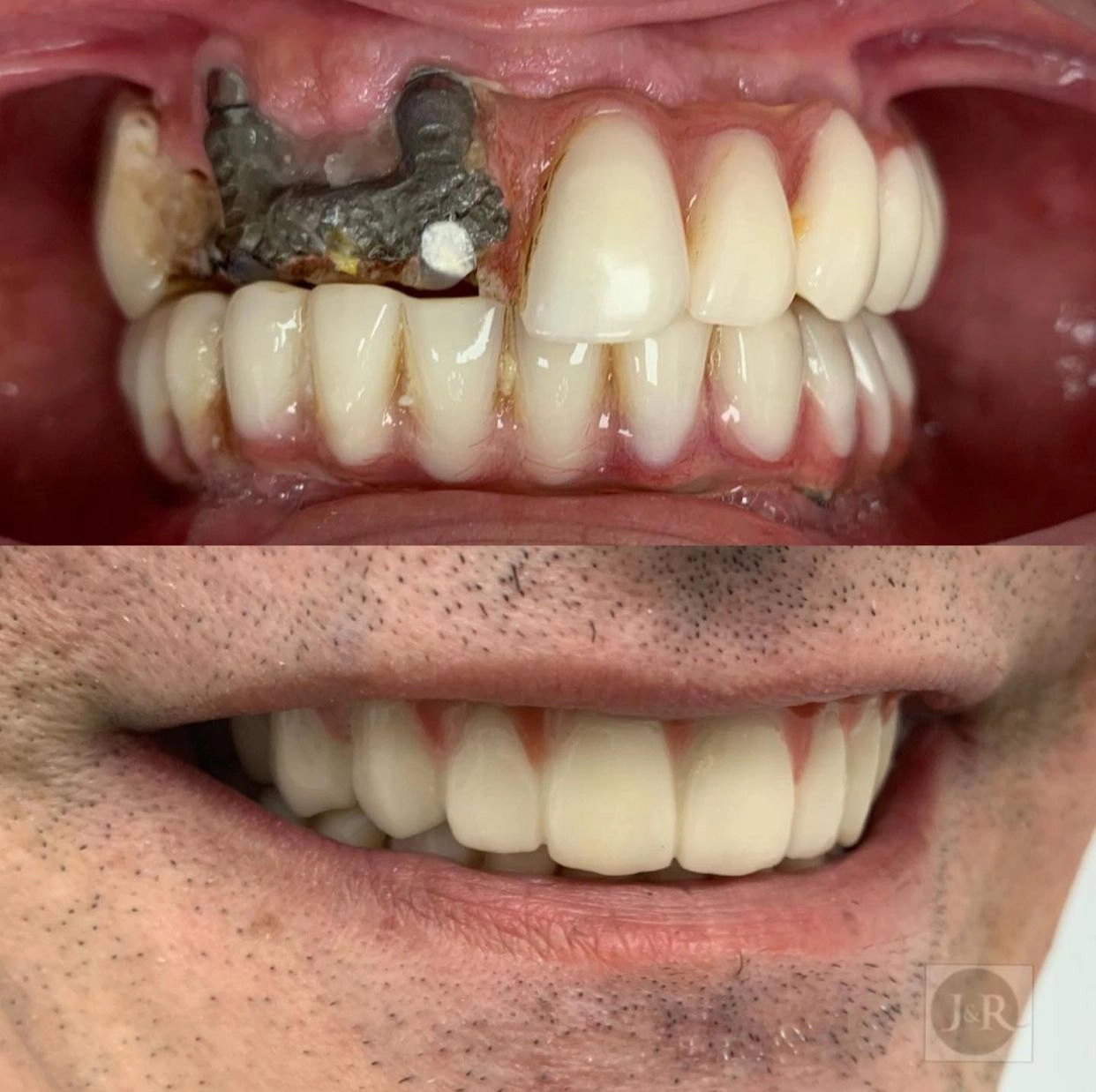 dental-implant-jandr-dental3.jpeg