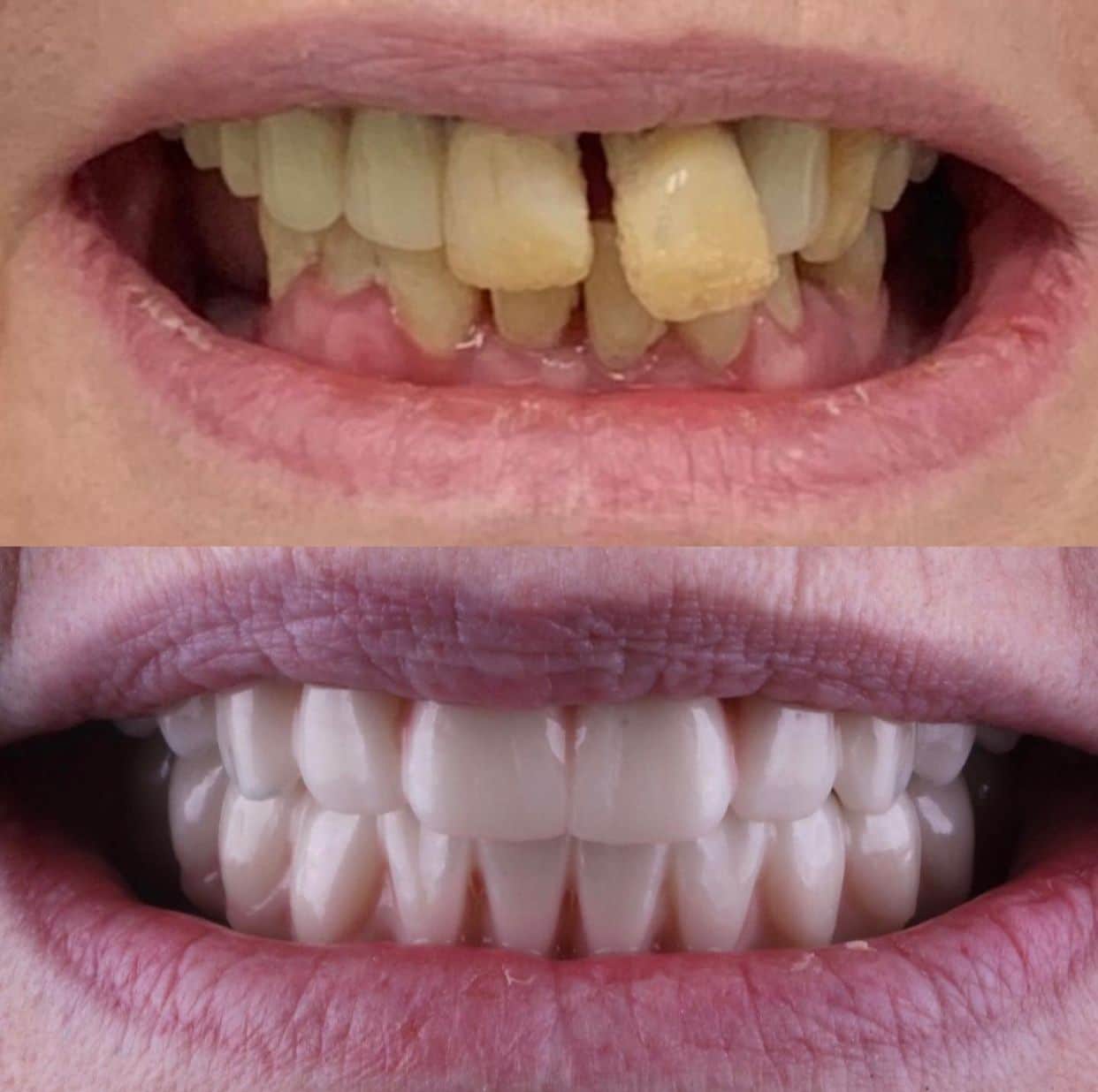 dental-implant-jandr-dental4 @ET-DC@eyJkeW5hbWljIjp0cnVlLCJjb250ZW50IjoicG9zdF90aXRsZSIsInNldHRpbmdzIjp7ImJlZm9yZSI6IiIsImFmdGVyIjoiIn19@