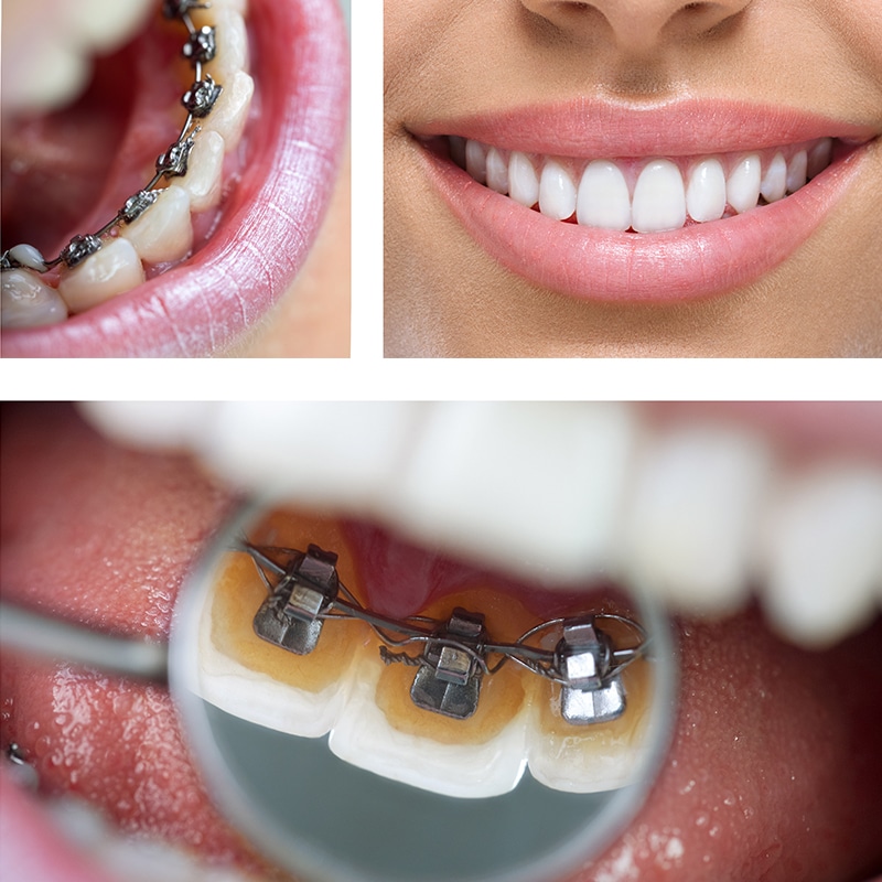 lingual braces Archives - First impression