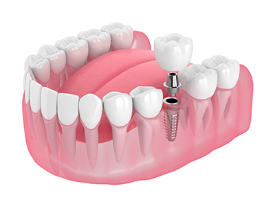 single-implant @ET-DC@eyJkeW5hbWljIjp0cnVlLCJjb250ZW50IjoicG9zdF90aXRsZSIsInNldHRpbmdzIjp7ImJlZm9yZSI6IiIsImFmdGVyIjoiIn19@